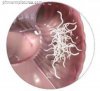 Pinworm-Infection-Treatment.jpg