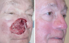 skin-cancer-spots-on-nose-facial-reconstruction-before-and-after-pictures-vysef9kk.png skin-cancer-spots-on-nose-facial-reconstruction-before-and-after-pictures-vysef9kk.png