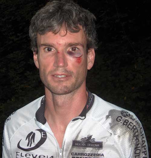 black-eye-grease-shoulder.jpg