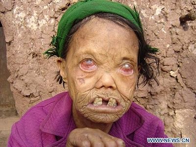 leprosy5.jpg