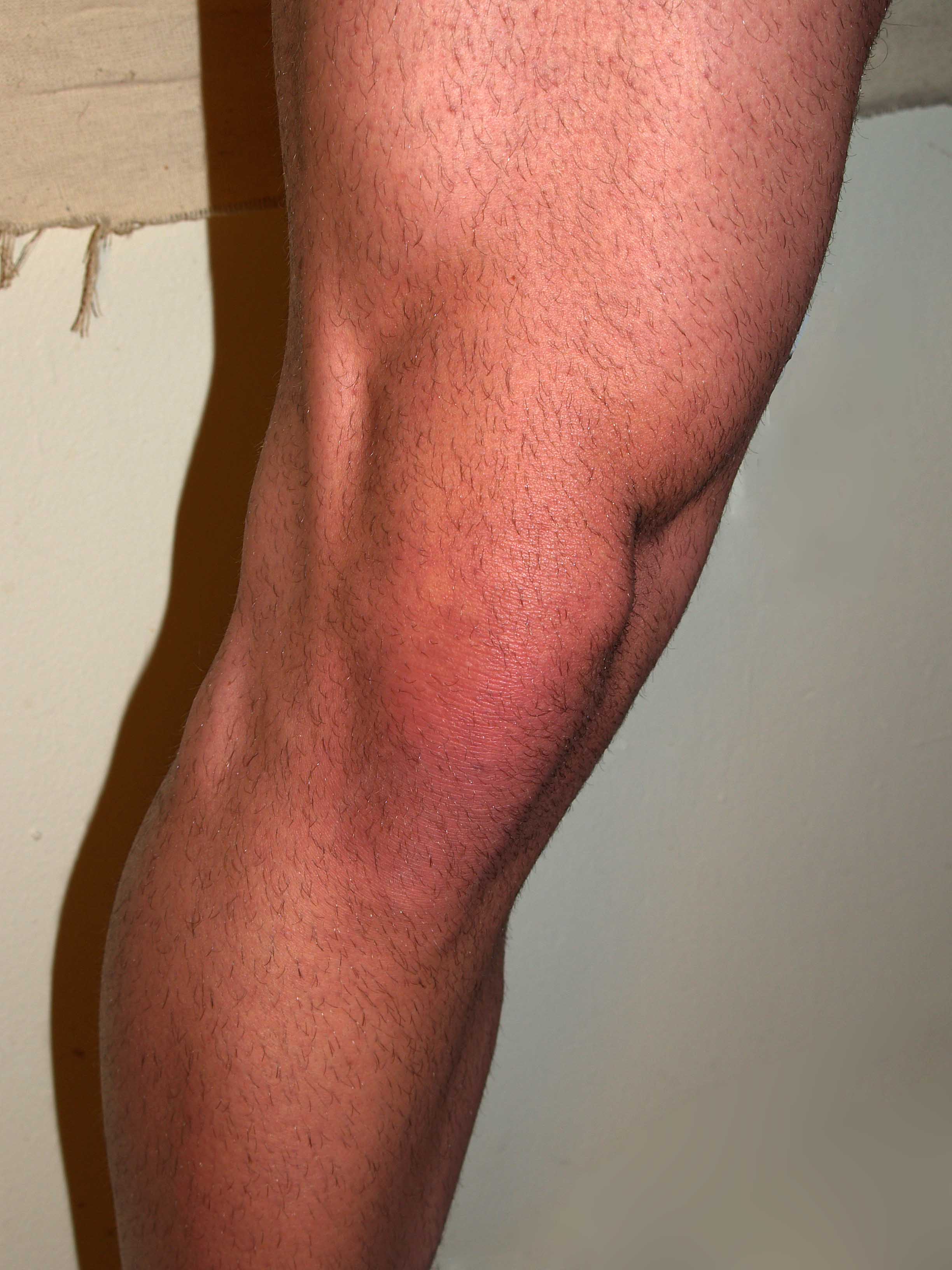 Male_Knee_by_David_Shankbone.jpg