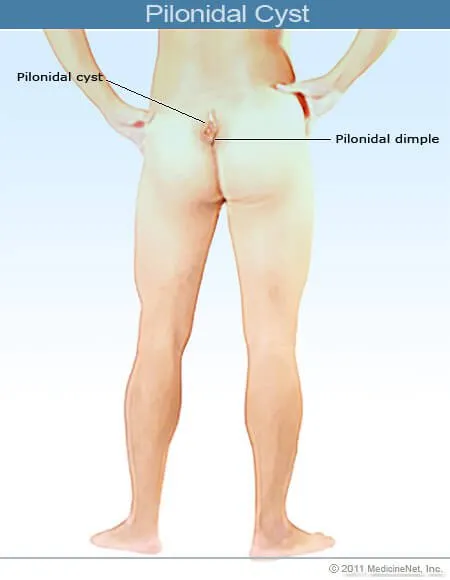 2011-pilonidal-cyst.jpg