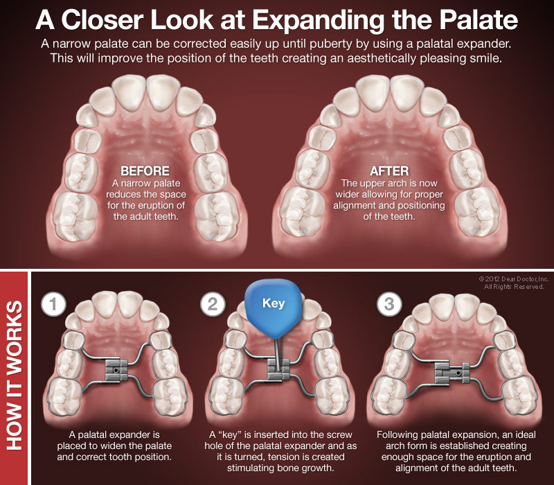 palatal-expanders.jpg