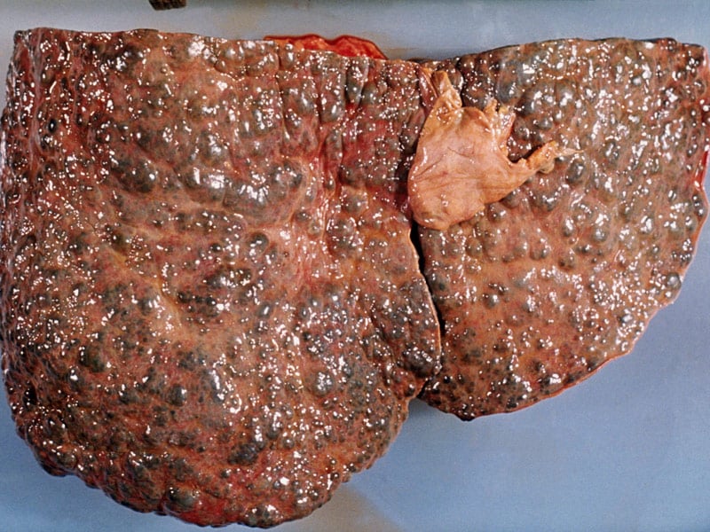 ps_150430_liver_cirrhosis_800x600.jpg