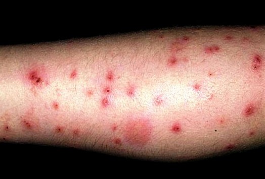 Bee-stings-swelling-524x355.jpg