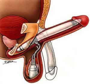 2-piece-penile-implant_AMS_Ambicor.jpg