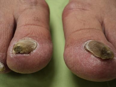 Listerine-Foot-Soak-for-Nail-Fungus.jpg